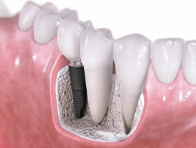 Dantų implantacija